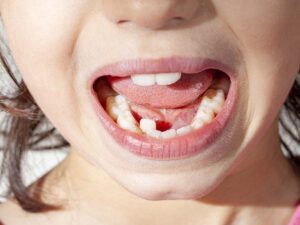 A crowded mouth of a child