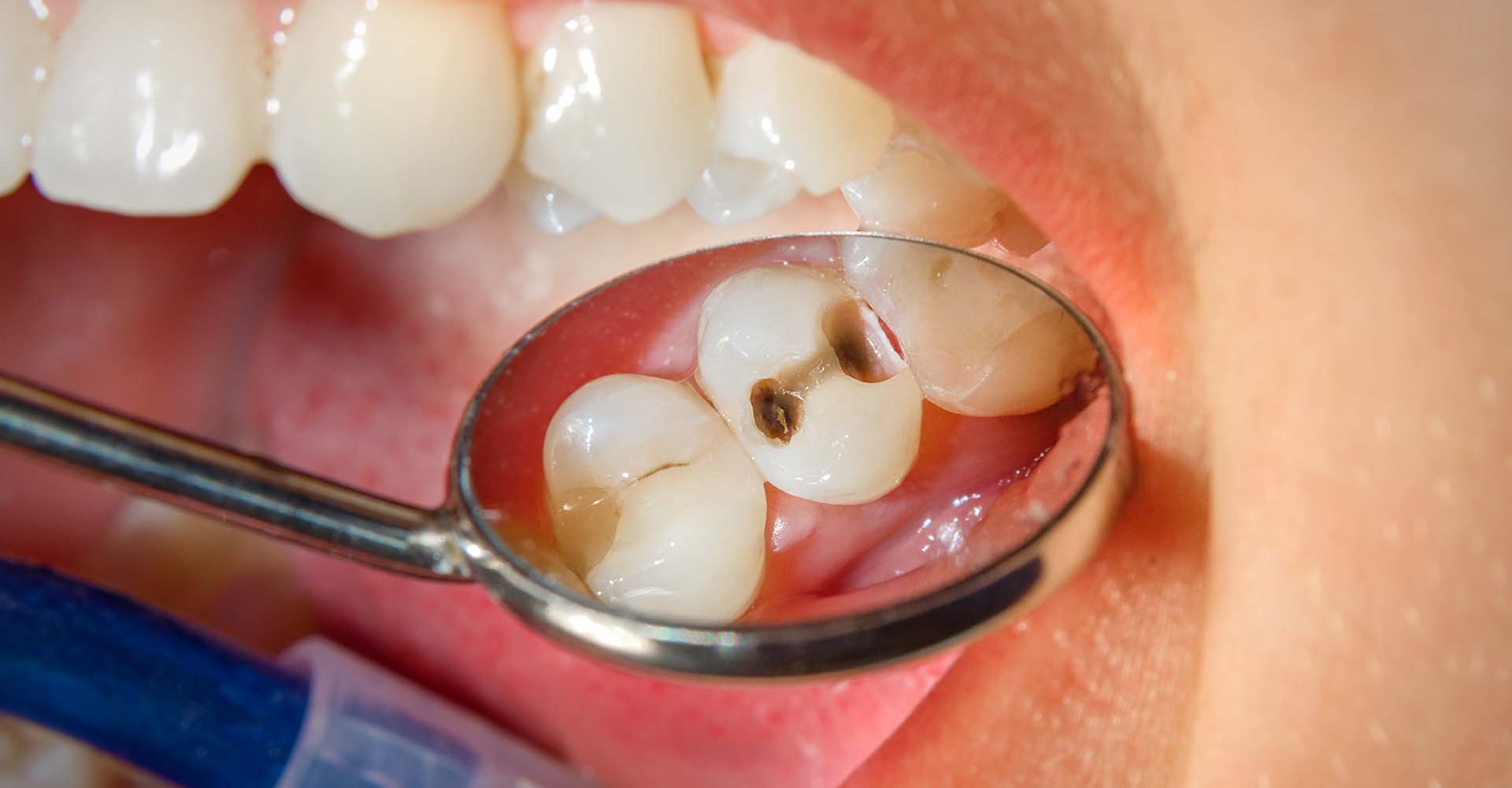 A dentist looking at cavities